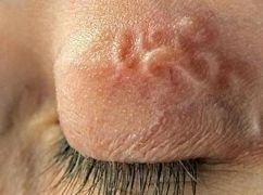 На Харківщині у жінки з ока витягнули 9-сантиметрового паразита