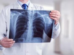 Медики назвали три райони Харківщини, де найбільше хворіють на туберкульоз