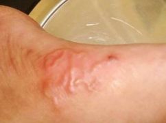 В Харькове врачи удалили с ноги женщины 10-сантиметрового гельминта