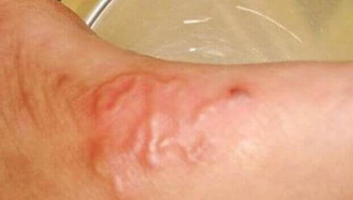 В Харькове врачи удалили с ноги женщины 10-сантиметрового гельминта