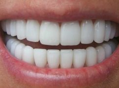 Важливість імплантації зубів