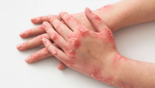 В Харьковской области возросла заболеваемость инфекционным паразитарным заболеванием кожи